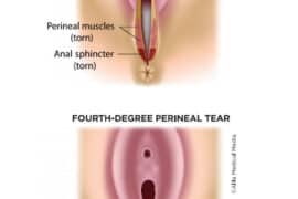 3rd degree vaginal tear