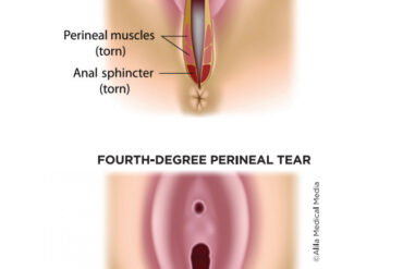 3rd degree vaginal tear