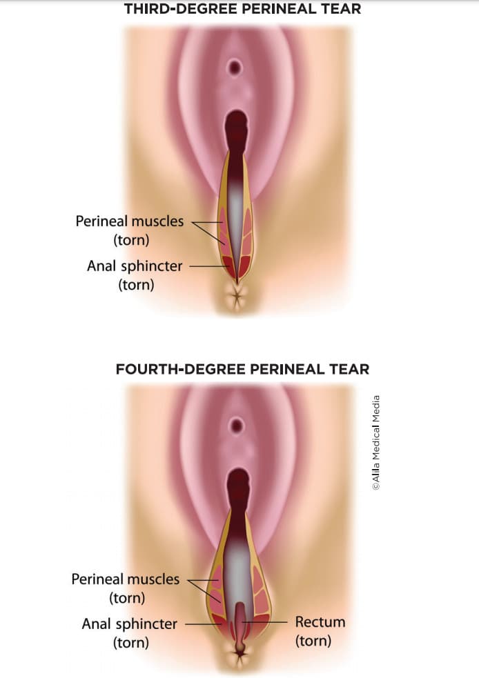 3rd degree vaginal tear