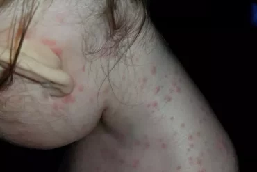 chicken pox or hand foot and mouth