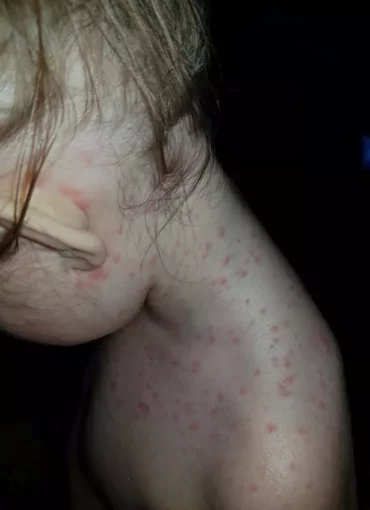 chicken pox or hand foot and mouth