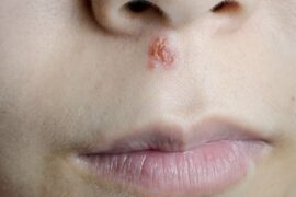 cold sore in nose or impetigo