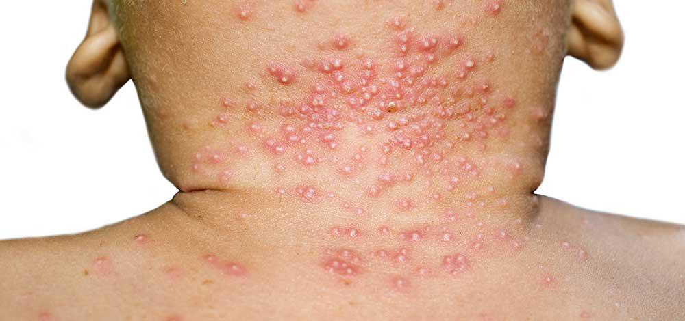 get-rid-of-cold-sores-and-impetigo-with-these-effective-tips