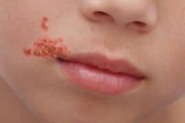 cold sore versus impetigo