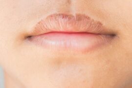 dry lips dehydration