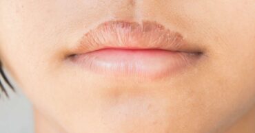 dry lips dehydration