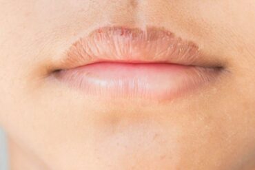 dry lips dehydration