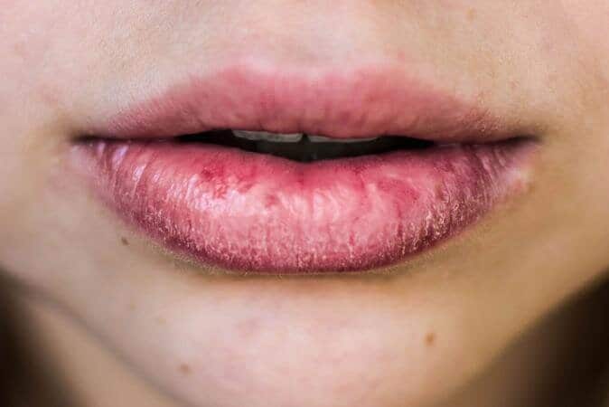 dry lips winter