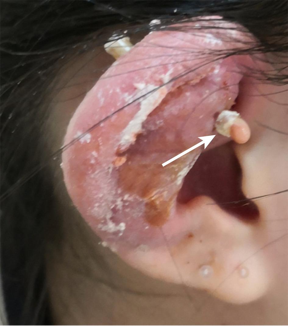 earring infection