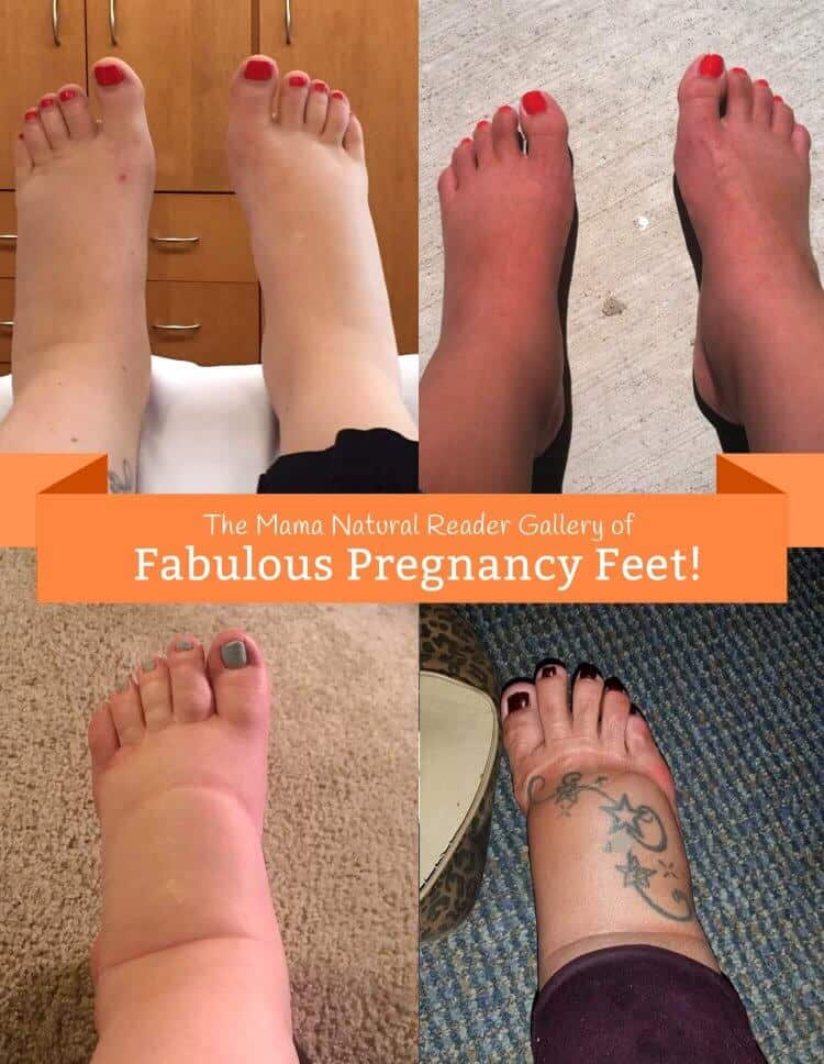 feet swelling and pregnancy