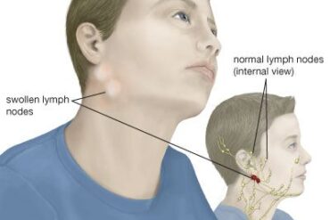 glandular fever signs