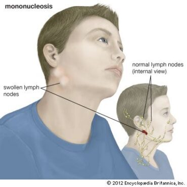 glandular fever signs