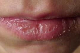 how to prevent cracked lips