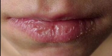 how to prevent cracked lips