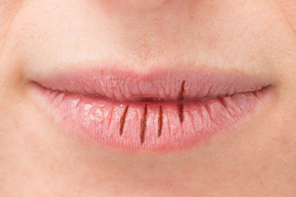 how to treat cracked lips