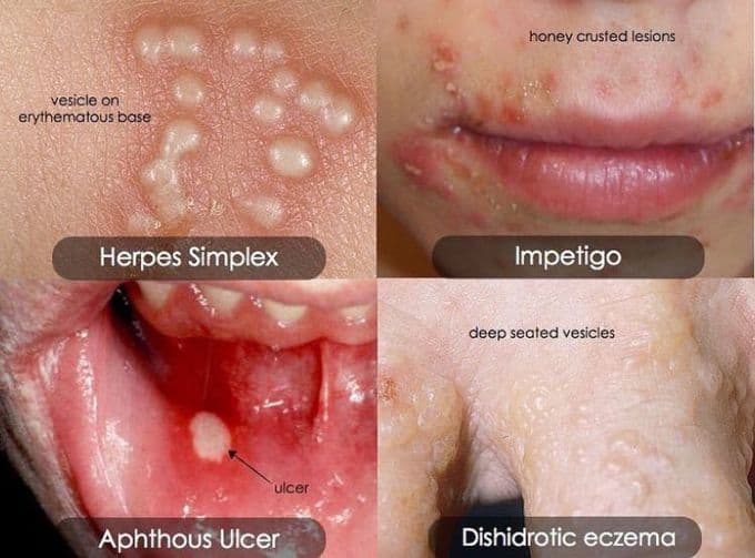 impetigo vs cold sore