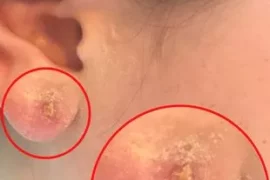 infected earring