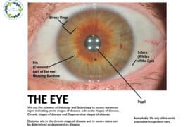 iridology pictures and meanings