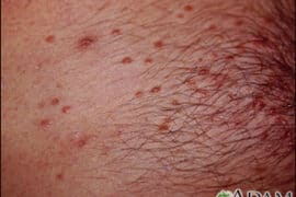 is molluscum contagiosum an std