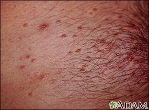 is molluscum contagiosum an std