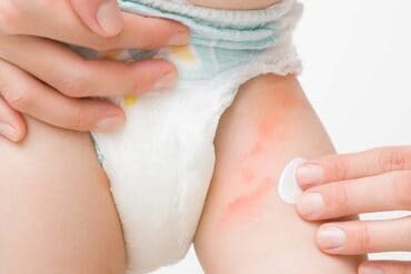 nappy rash spots