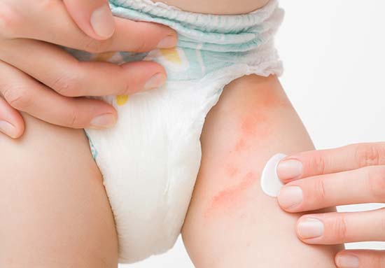 nappy rash spots