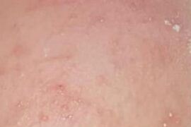 nappy rash white spots