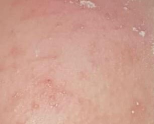 nappy rash white spots