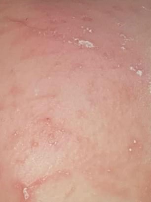 nappy rash white spots