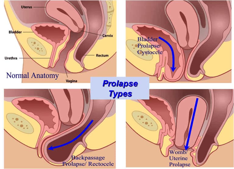 prolapse symptoms after birth