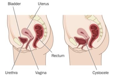 prolapsed uterus after birth