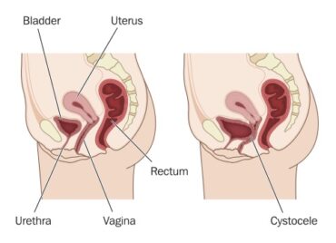 prolapsed uterus after birth