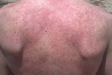 roseola in adults