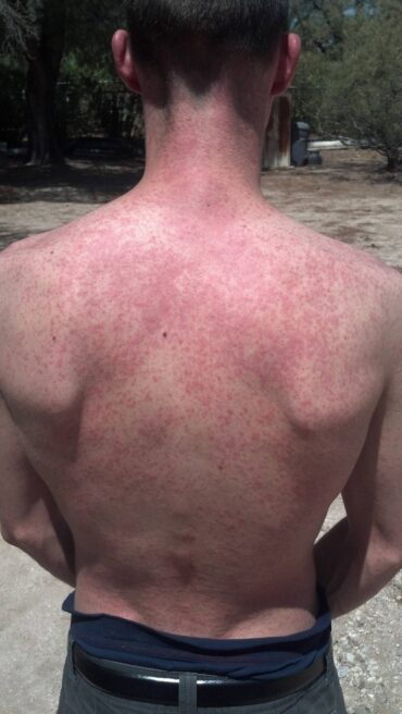 roseola in adults