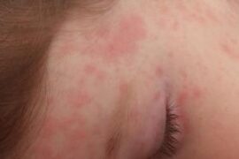 roseola in adults symptoms