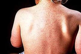 roseola rash adults