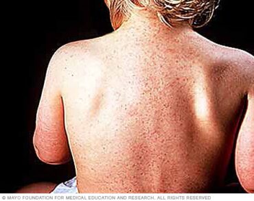 roseola rash adults