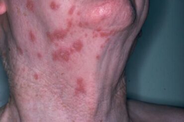 roseola rash in adults