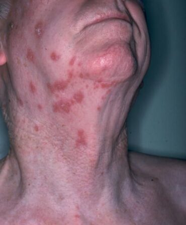 roseola rash in adults