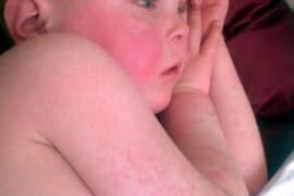 scarlet fever or slapped cheek