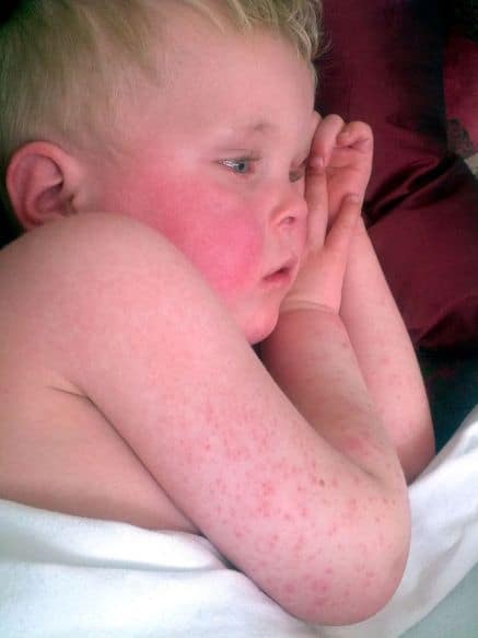 scarlet fever or slapped cheek