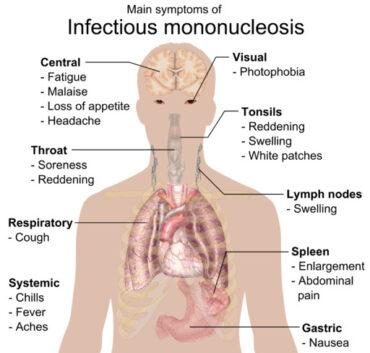 symptoms glandular fever