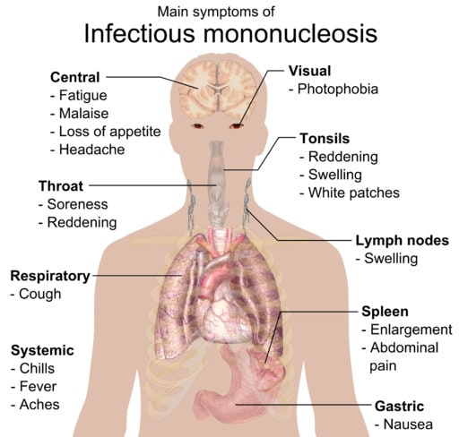 symptoms glandular fever