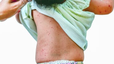 symptoms of roseola in adults