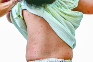 symptoms of roseola in adults