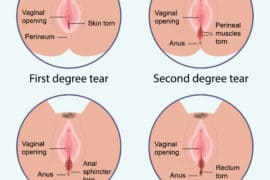 3rd degree tear birth