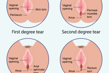 3rd degree tear birth