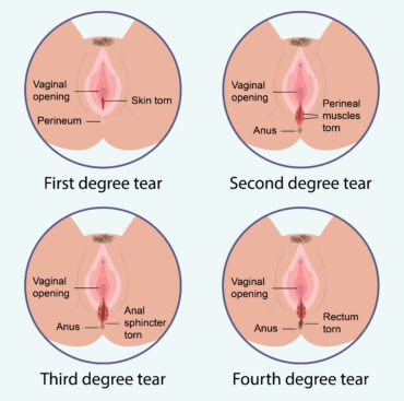 3rd degree tear birth