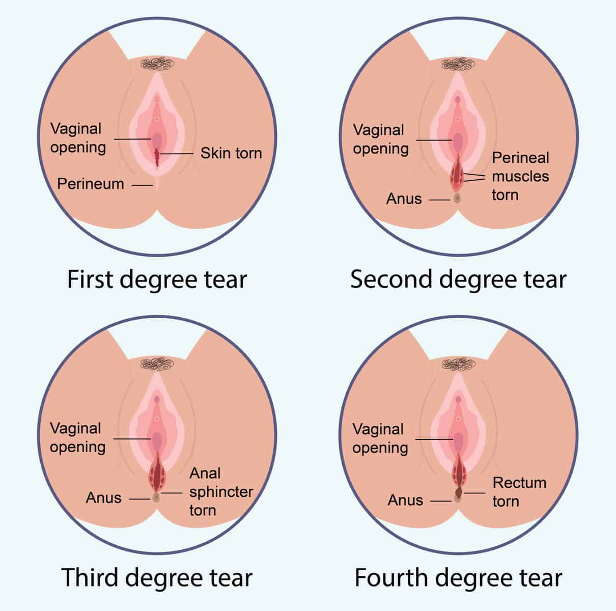 3rd degree tear birth