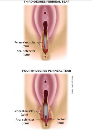 3rd degree tear in childbirth